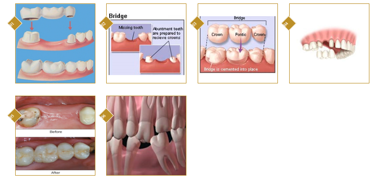 Best Dental Crown treatment in BTM Layout