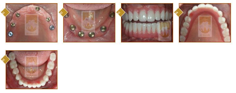 Dental Implants in Marathahalli